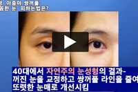 일명 '아줌마 쌍꺼풀' '빠꼼한 눈' 피하는 수술법 - 비 절개 상안검 수술(자연주의 눈성형)